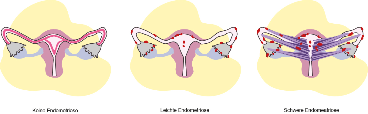 Endometriose Schweregrad